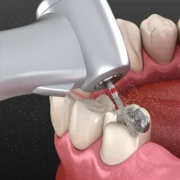 Amalgam Removal